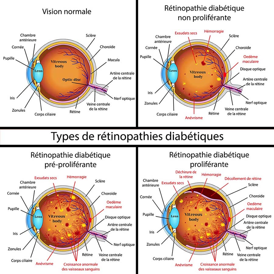 Type de r&eacute;tinopathies diab&eacute;tique