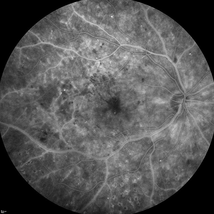 Diabete et r&eacute;tine