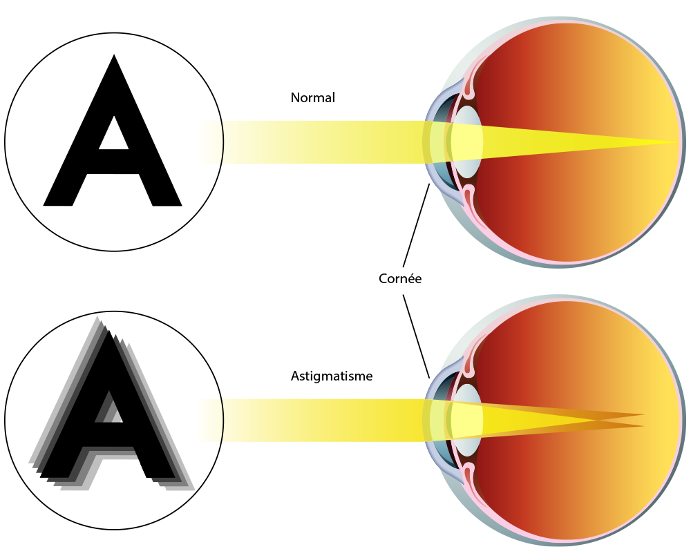 Astigmatisme - Visiop&ocirc;le du Beaujolais