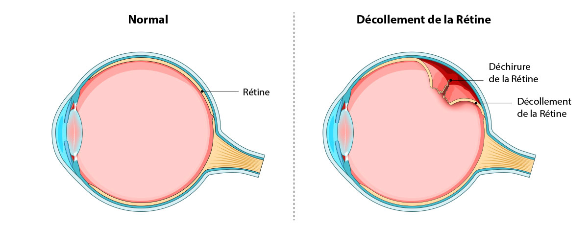 D&eacute;chirure de la r&eacute;tine