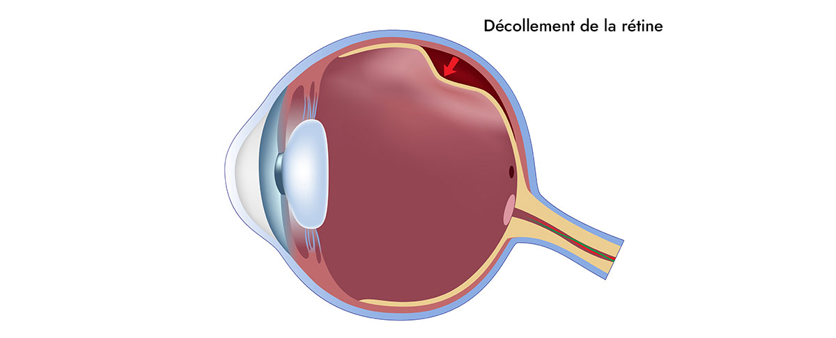 Dhema d&eacute;collement de la r&eacute;tine