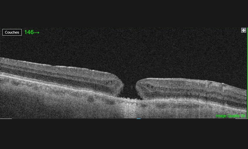 Trou maculaire-Visiop&ocirc;le du beaujolais