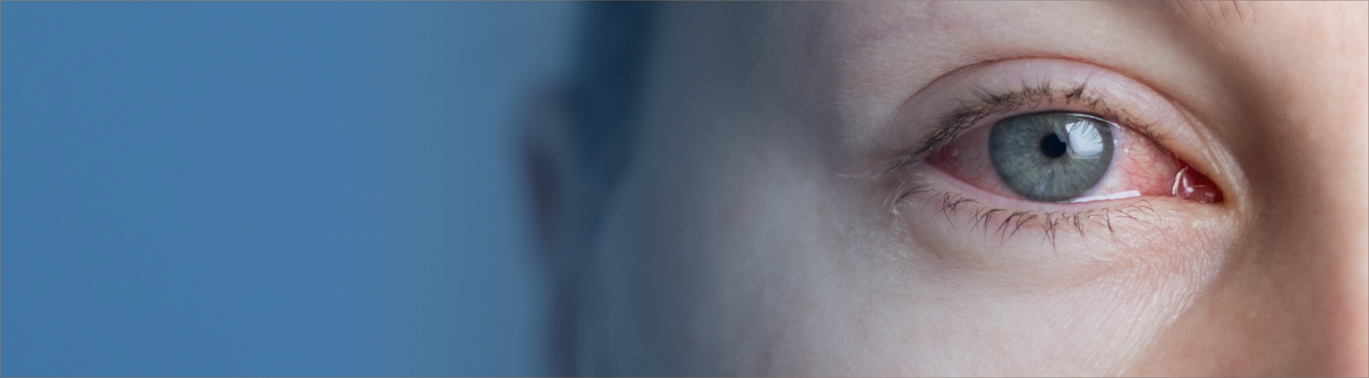 k&eacute;ratoconjonctivite