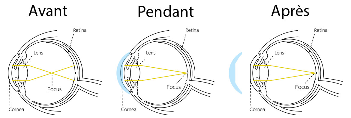 orthok&eacute;ratologie shema