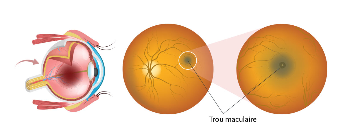 shema trou maculaire