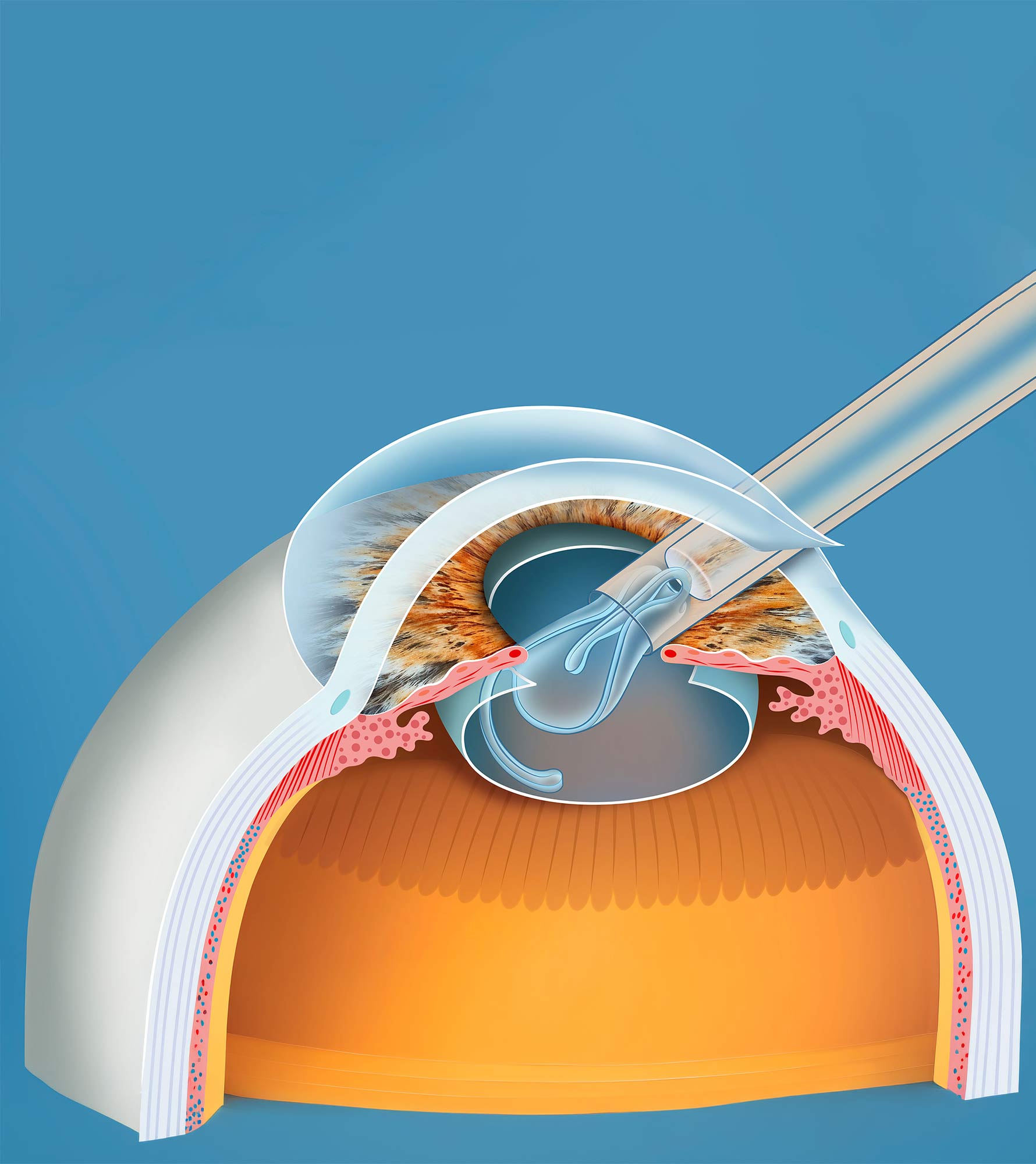 Implant en train d&rsquo;&ecirc;tre inject&eacute; dans l&rsquo;&oelig;il