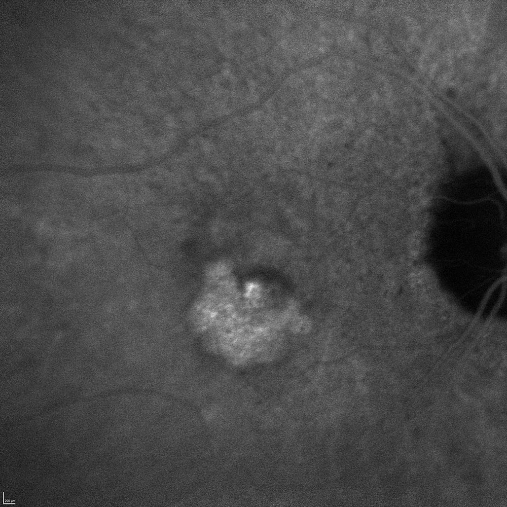 N&eacute;ovaisseaux (occultes)DMLA