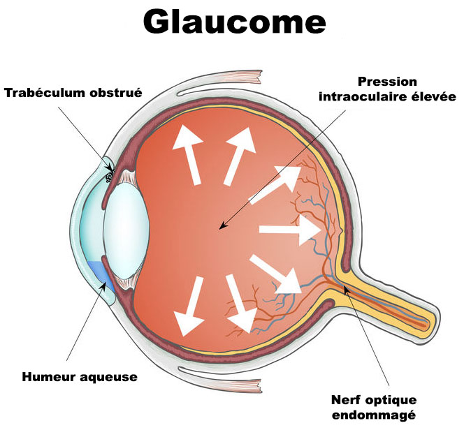 Illustration vectorielle - Œil humain - glaucome