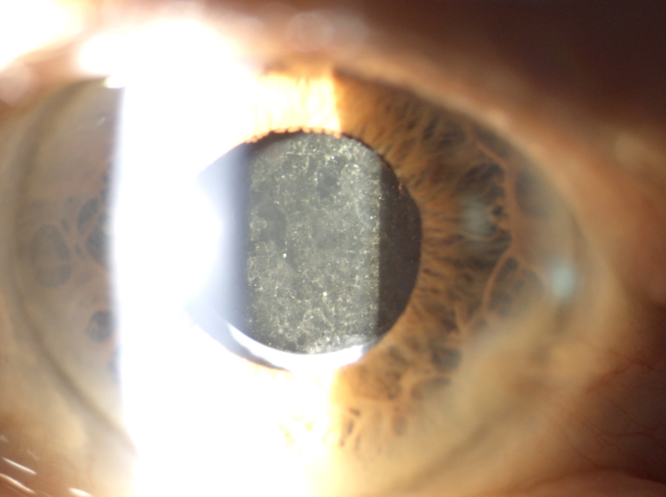 Cataracte secondaire | Visiopôle du Beaujolais | cataracte secondaire laser | Villefranche-sur-Saône