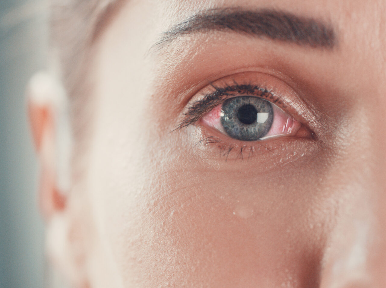 Kératoconjonctivite Visiopôle du Beaujolais VillefranchesurSaône