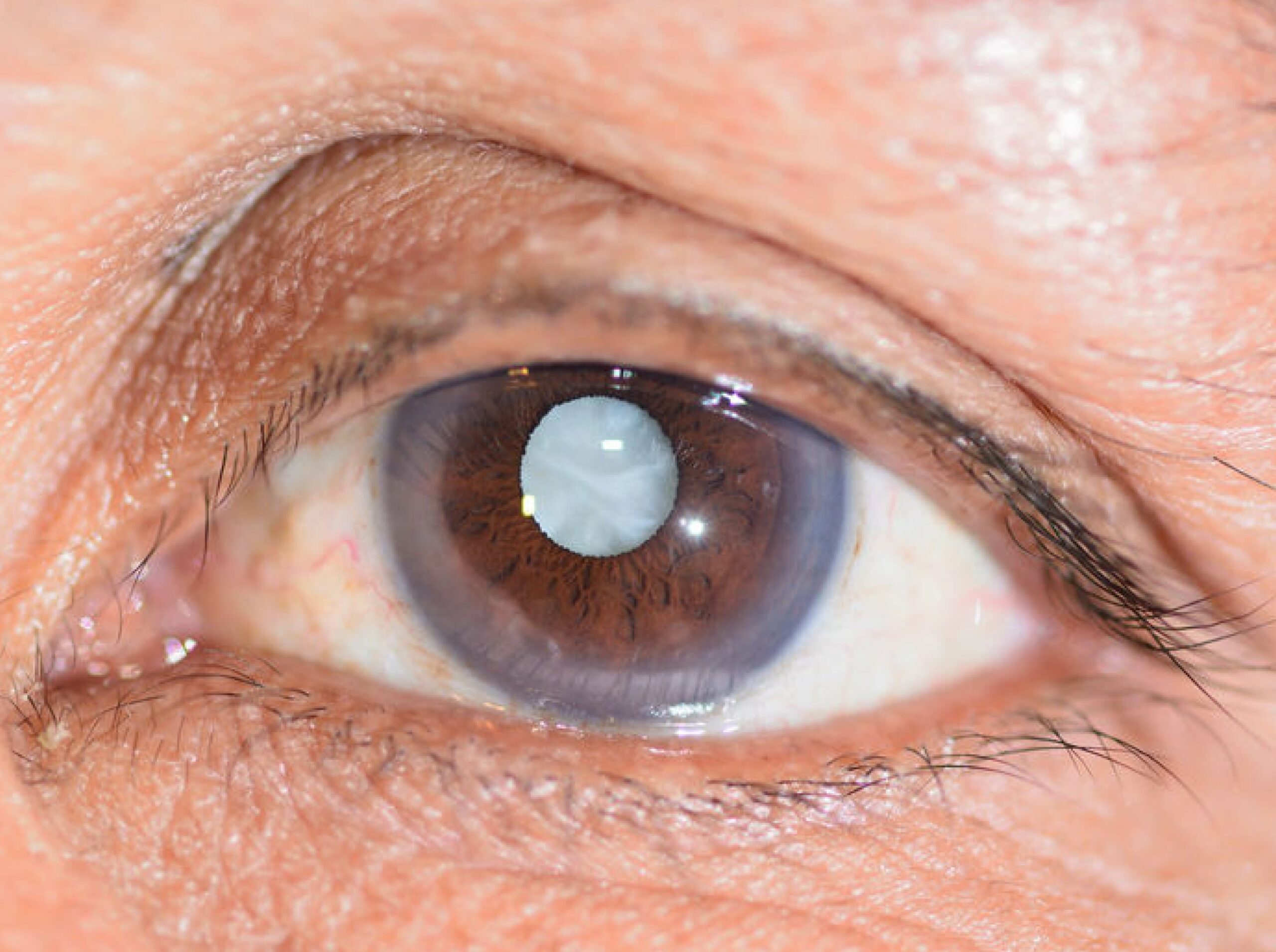 La cataracte | Visiopôle du Beaujolais | symptomes cataracte, cataracte oeil | Villefranche-sur-Saône