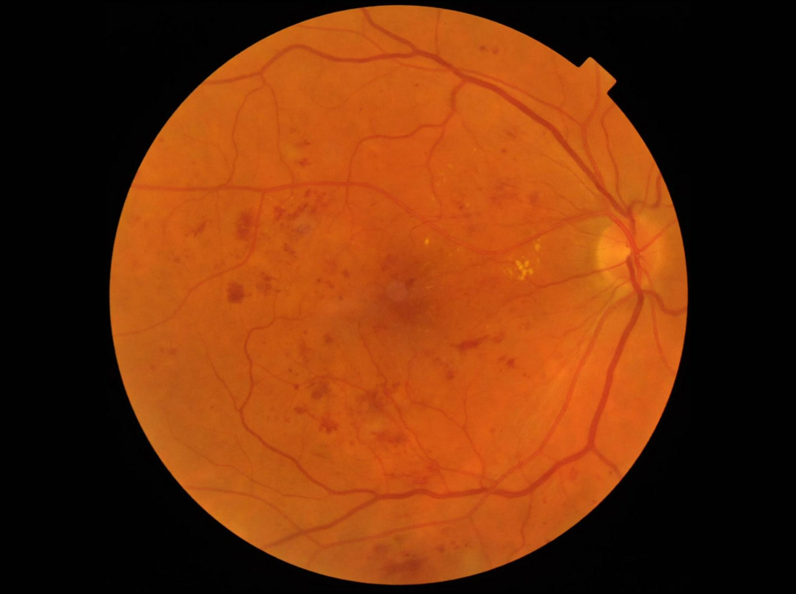 Ангиопатия сосудов мкб. Диабетическая ретинопатия неоваскуляризация. Диабетическая ретинопатия офтальмоскопия. Пролиферативная ретинопатия. Диабетическая ретинопатия глазное дно.